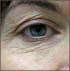 laser-patient-01a