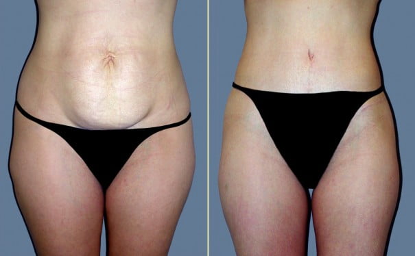 Combining liposuction with a tummy tuck photo