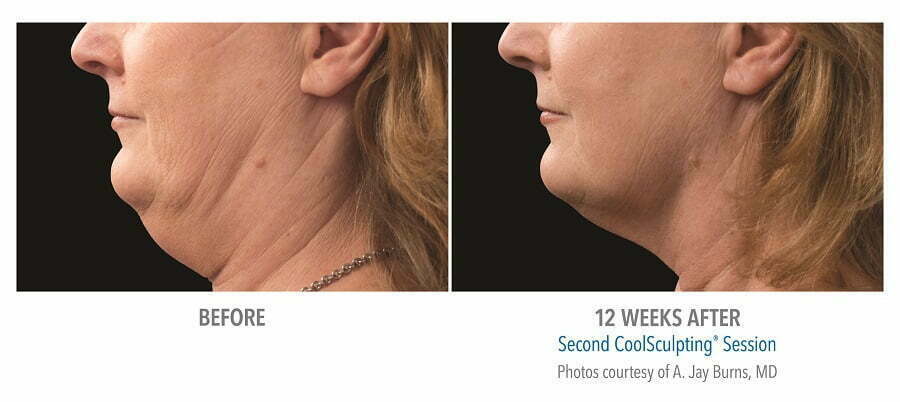 before & after coolmini chin fat reduction