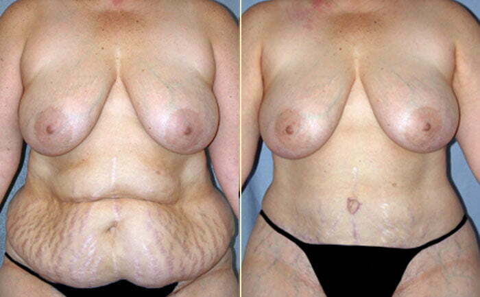 Tummy Tuck Patient 02