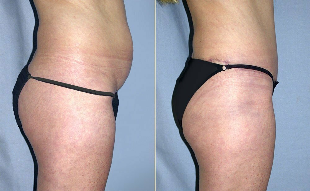 Tummy Tuck Patient 03