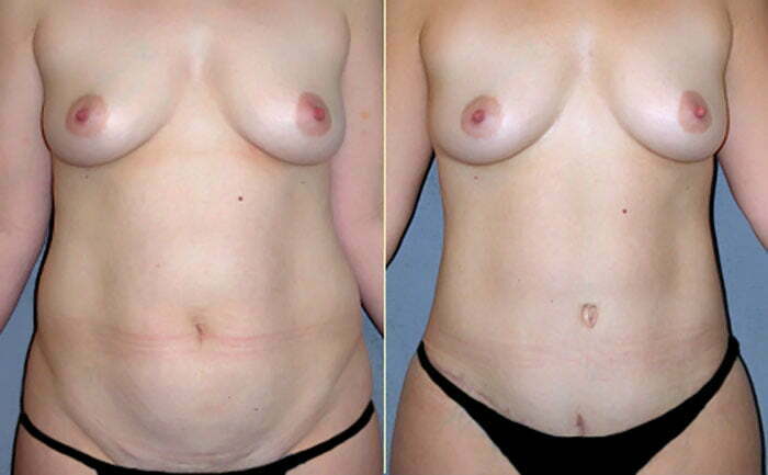 Tummy Tuck Patient 04