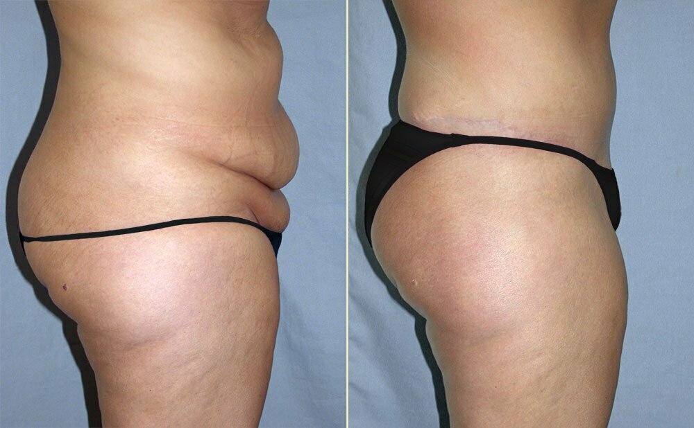 Tummy Tuck Patient 05