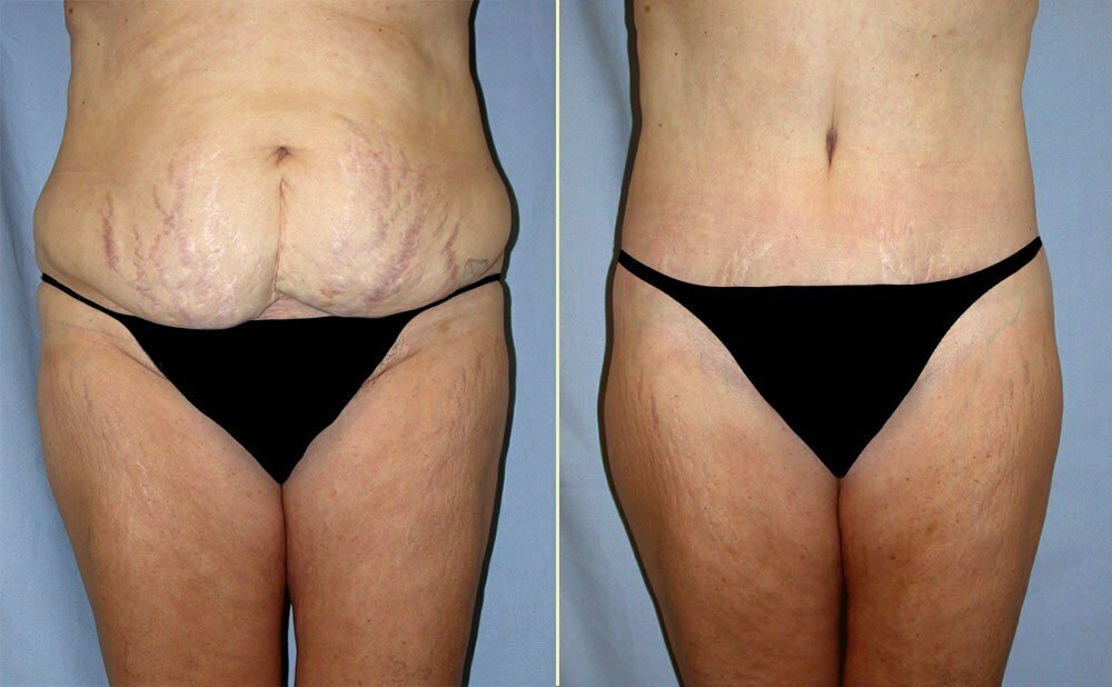 Tummy Tuck Patient 07