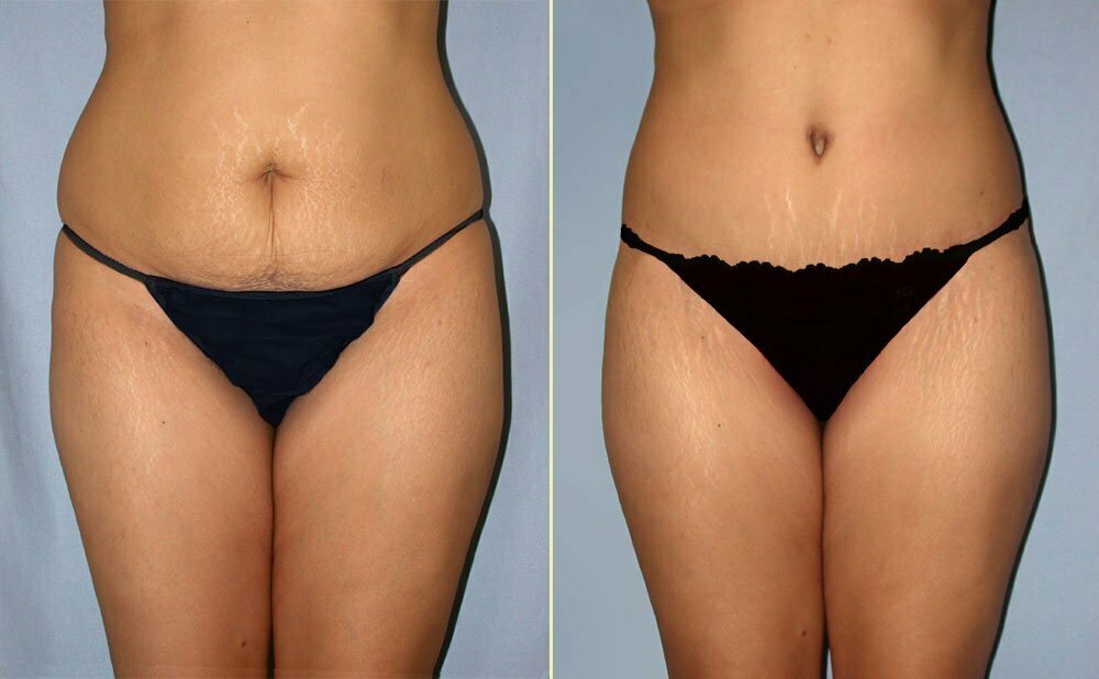 Tummy Tuck Patient 08