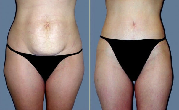Combining liposuction with a tummy tuck photo Combining liposuction with a tummy tuck photo