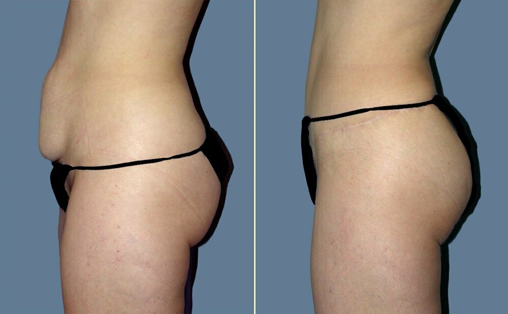 Tummy Tuck Patient 09