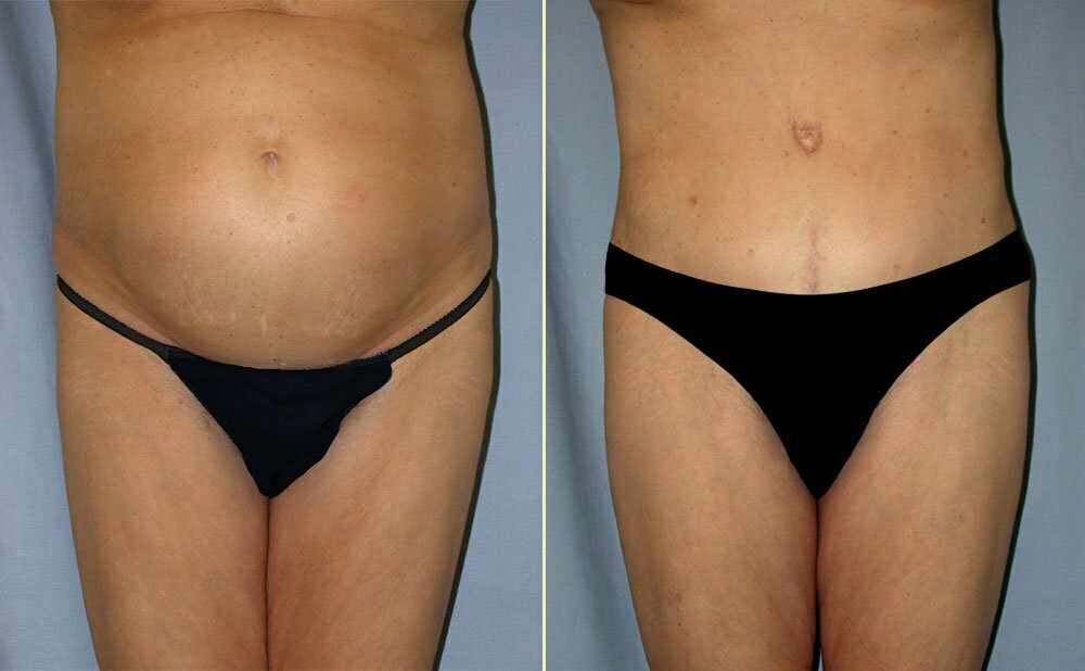 Tummy Tuck Patient 10