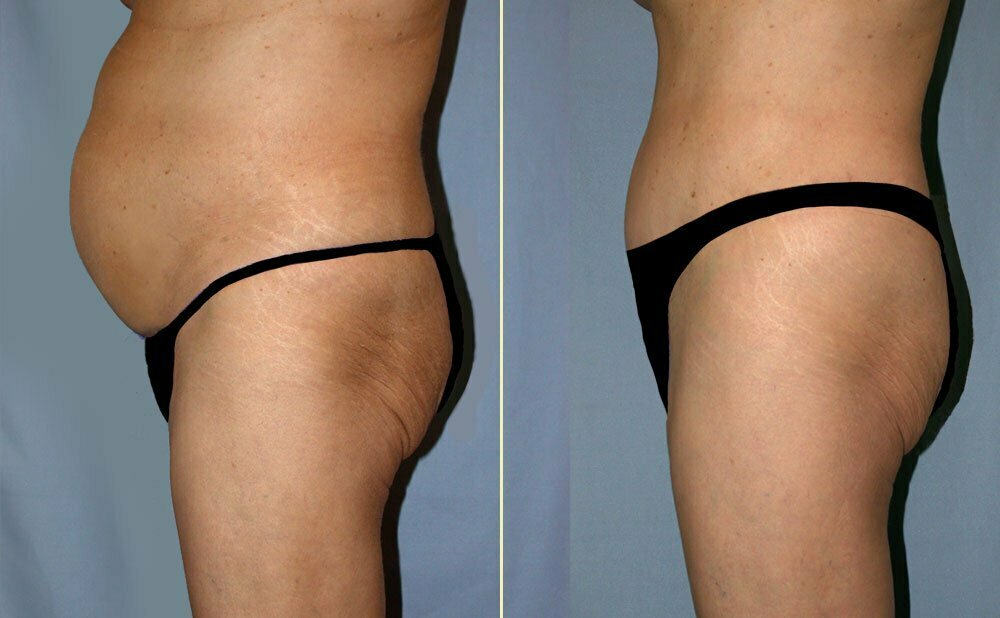 before and after abdominoplasty