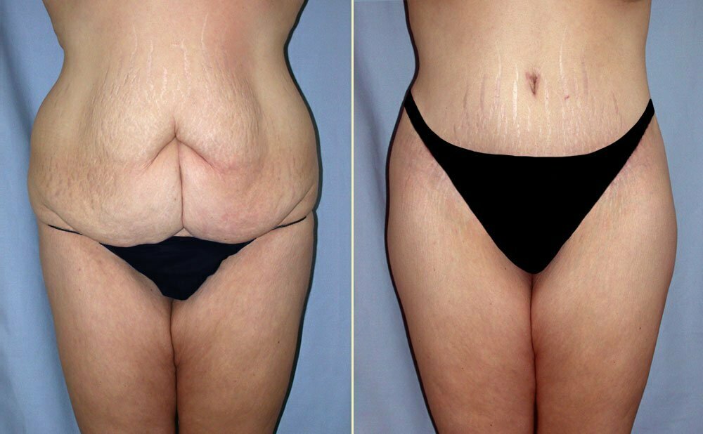 before and after abdominoplasty