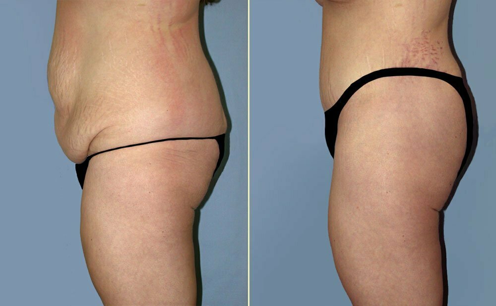 Tummy Tuck Patient 11