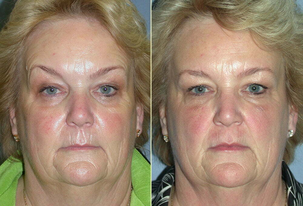 Botox & Restylane Patient 01