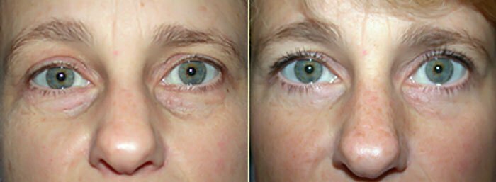 Lower eyelid surgery creates a smoother contour to the lower eyelids
