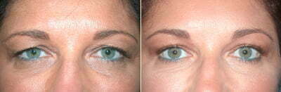 Upper Eyelid Lift with Endoscopic Brow Lift