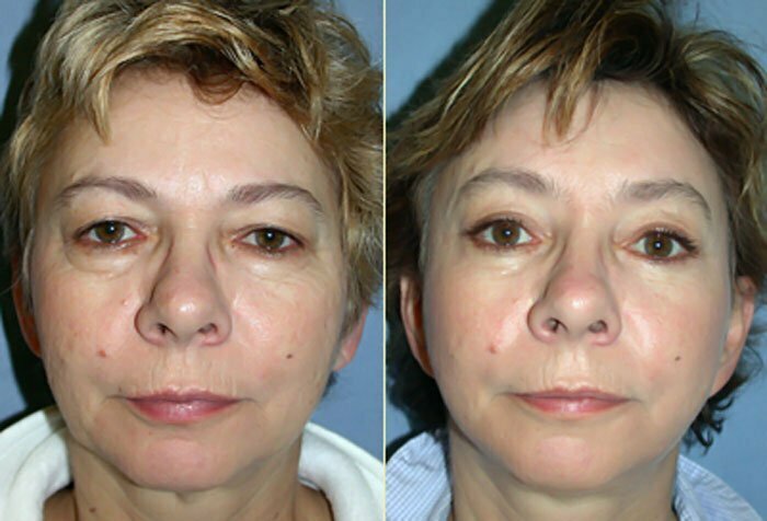 Upper & Lower Eyelid Lift combined with Face & Neck Lift and Endoscopic Brow Lift*