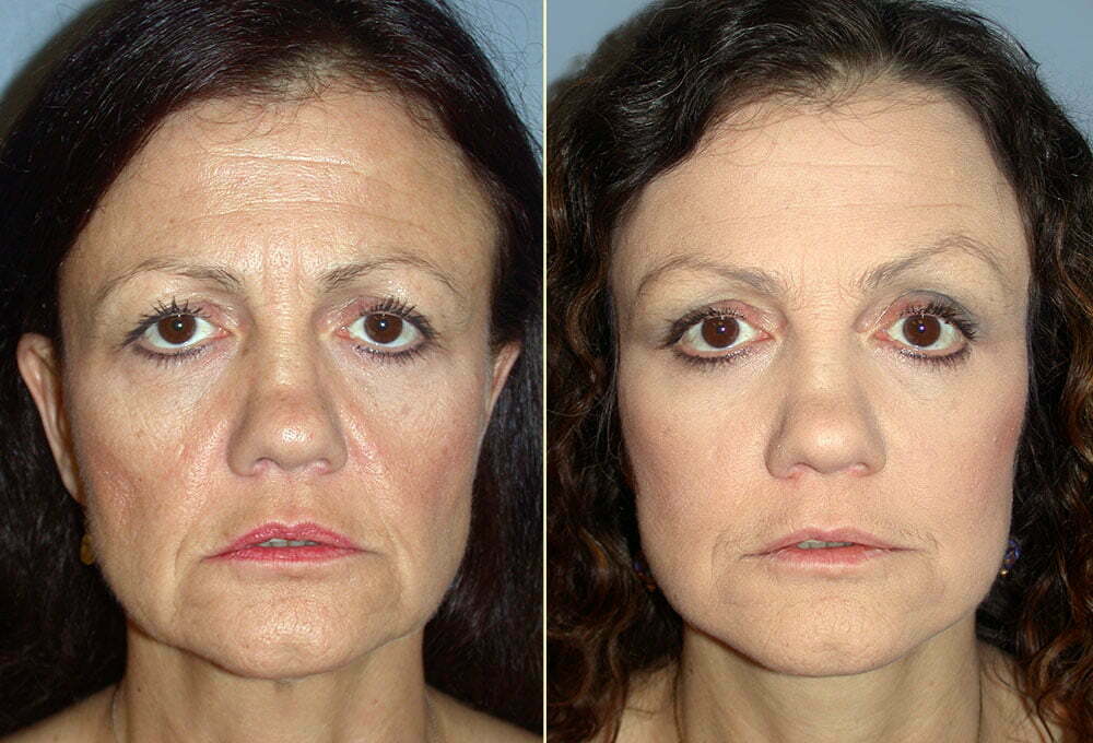 Facelift Patient 09