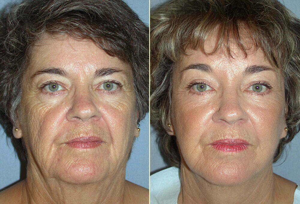 Facelift Patient 10