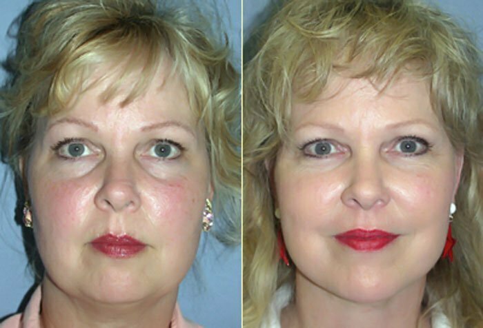 Facelift Patient 06