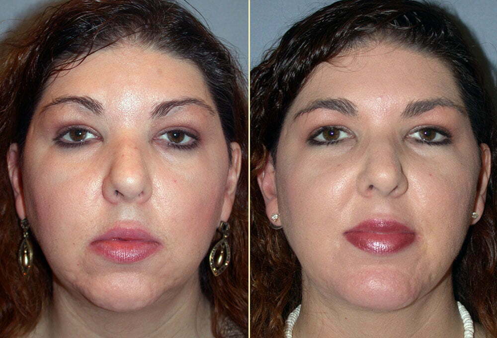 Neck Contouring Patient 10