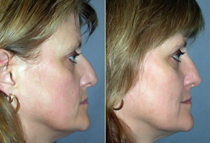 Rhinoplasty Before and After Side View 02