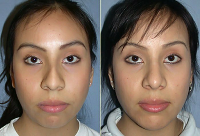 Chin Implant 1 - Dr. Movassaghi