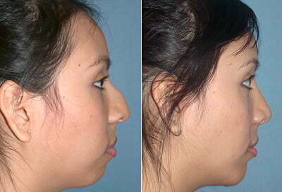 Combining rhinoplasty with chin implant surgery