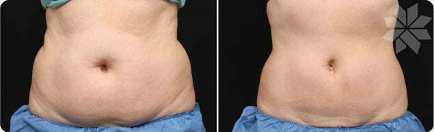 Coolsculpting Phoenix