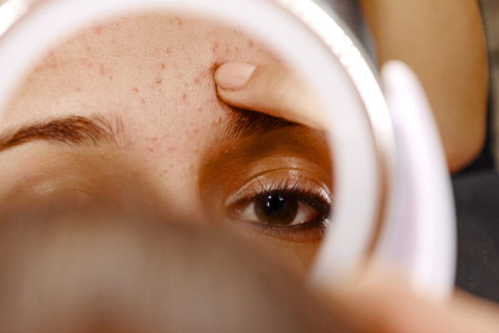 Close up of girl with acne looking at forehead in mirror