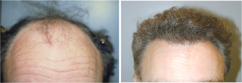 before and after neograft