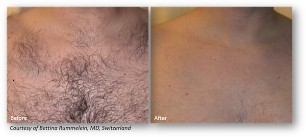 Before & after picture laser hair removal series with Clarity Before & after picture of laser hair removal series with Clarity