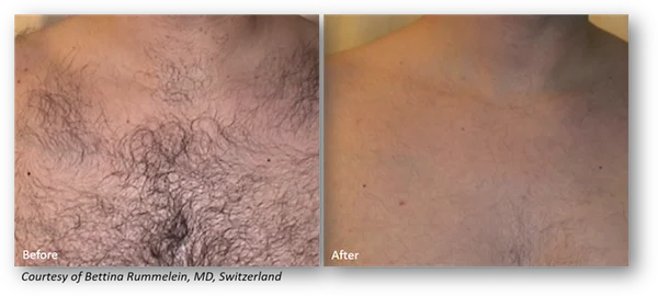 Before & after picture of laser hair removal series with Clarity 