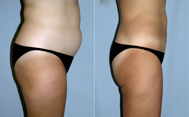before and after liposcution