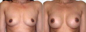 Breast Augmentation Patient 26