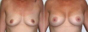 Breast Augmentation Patient 27