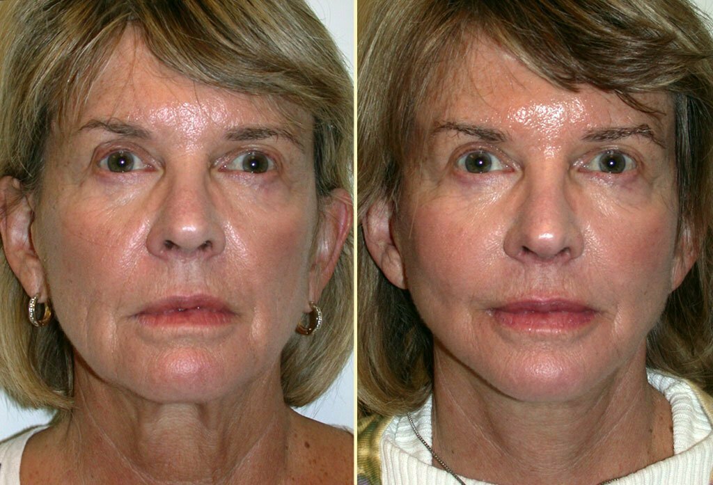 Facelift Patient 11