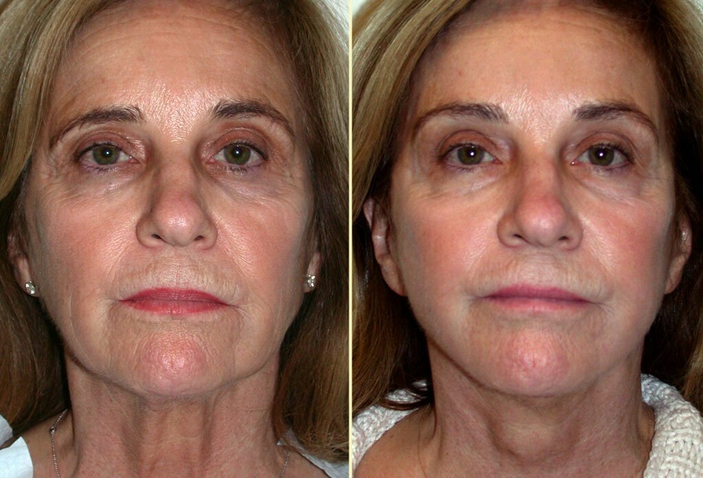 Facelift Patient 12