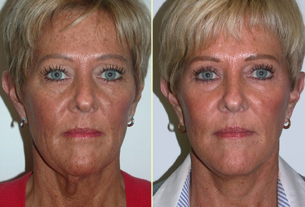 Facelift Patient 13