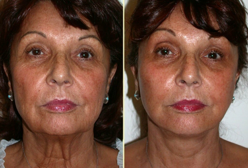 Facelift Patient 14