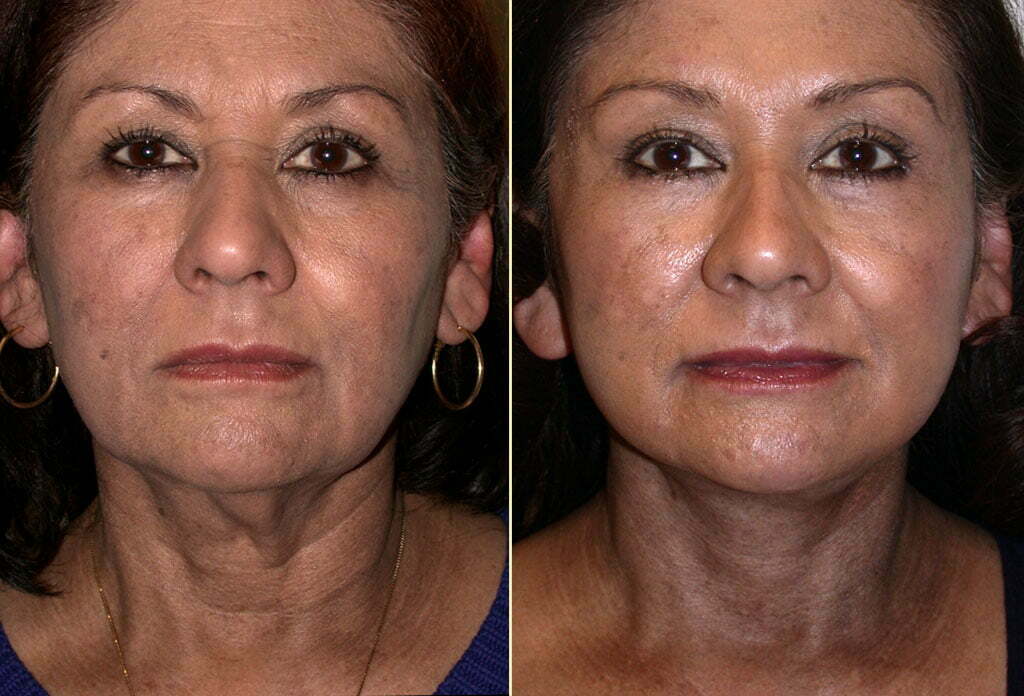 Facelift Patient 18