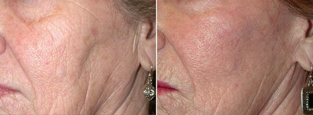 FX Laser Skin Resurfacing Patient 3