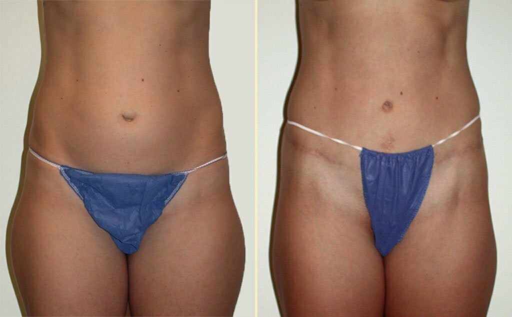 HLTA Tummy Tuck Patient 2