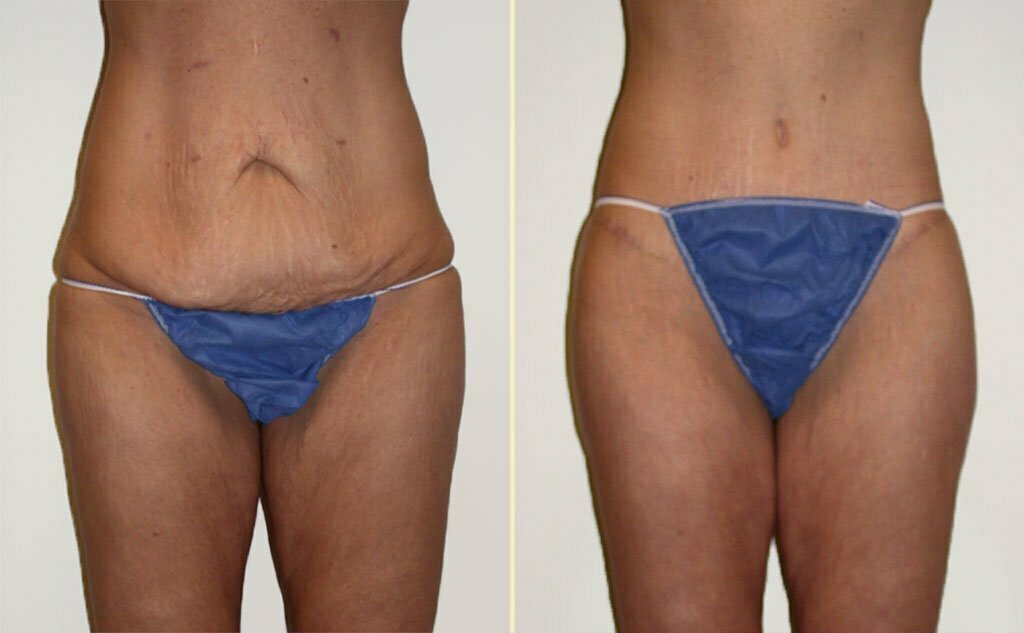 HLTA Tummy Tuck Patient 3