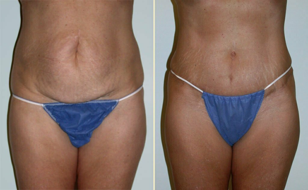 HLTA Tummy Tuck Patient 4