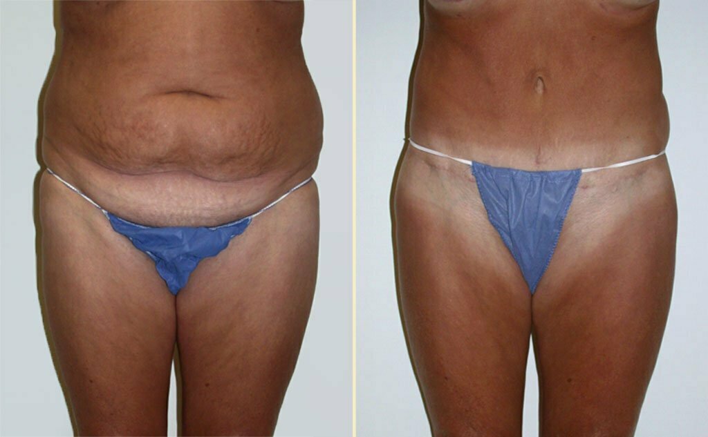 HLTA Tummy Tuck Patient 5