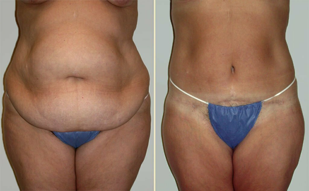 HLTA Tummy Tuck Patient 6