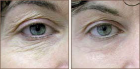 laser patient before and after photo