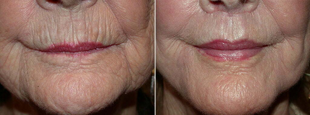FX Laser Skin Resurfacing and Lip Lift Patient 1