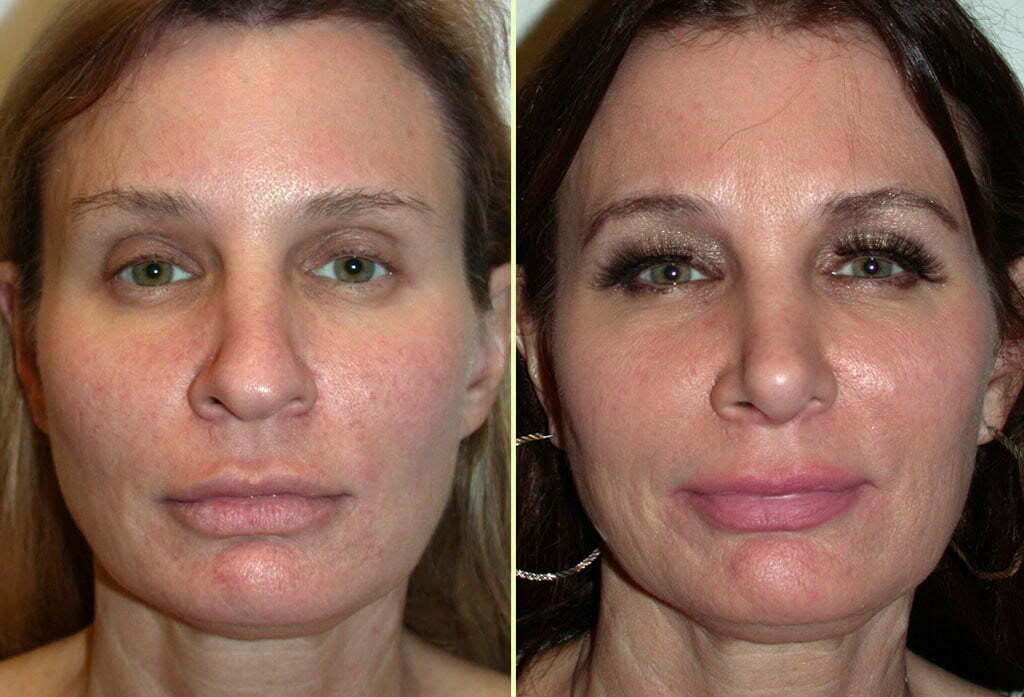 Rhinoplasty Patient 9