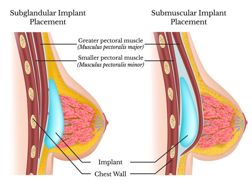 Under the muscle breast implant placement (submuscular) vs Over the muscle placement (subglandular)