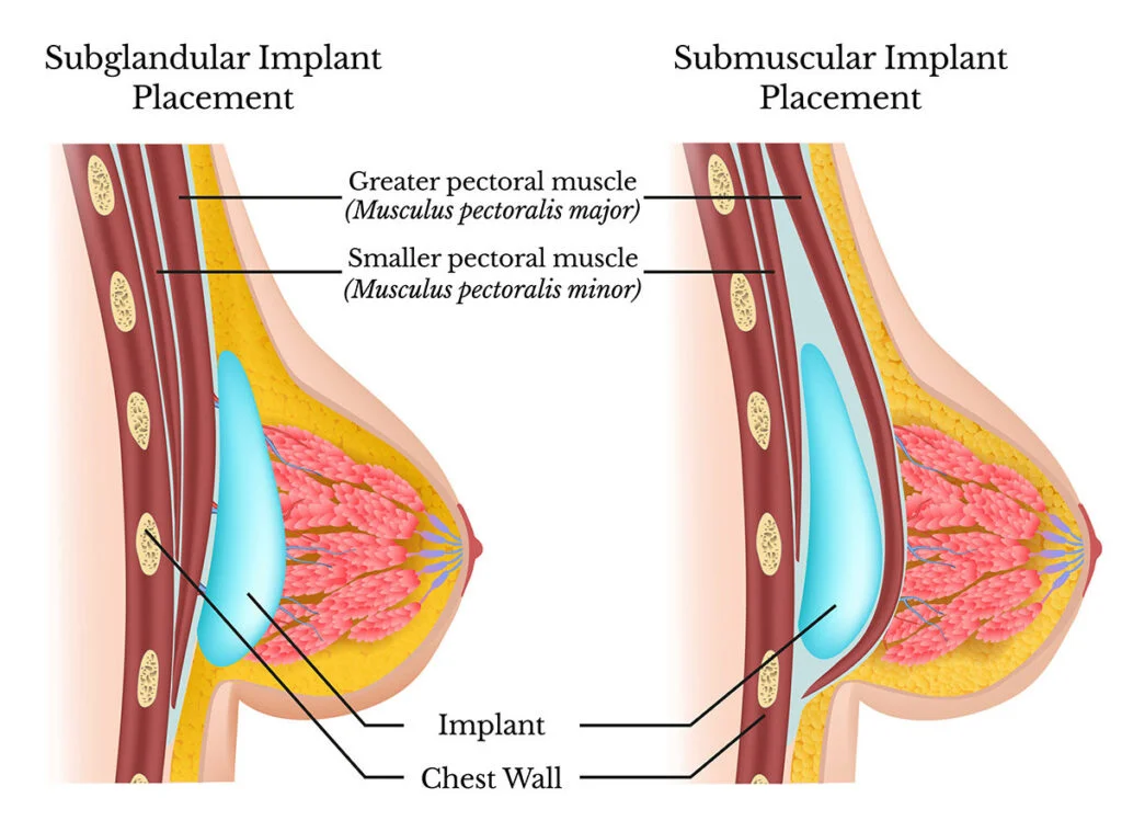 Under the muscle breast implant placement (submuscular) vs Over the muscle placement (subglandular)